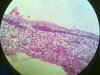 metaplasia-3