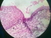 metaplasia-4