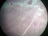 palatine-tonsils-2