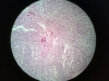 palatine-tonsils-3