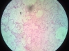pulmonary-edama