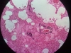 pulmonary-edema-10x