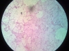 pulmonary-edema