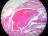 thrombosis-1