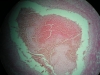 thrombosis-2