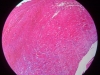 thrombosis-4