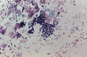 Adenocarcinoma of Vagina
