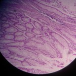 adenocarcinoma colon