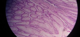 Adenocarcinoma Colon