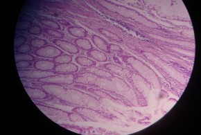 Adenocarcinoma Colon