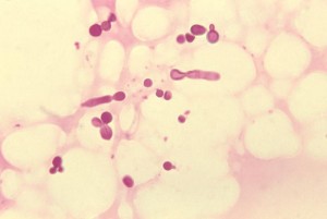 Malassezia furfur in skin scale from a patient with tinea versicolor