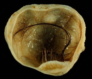 Mature cystic teratoma