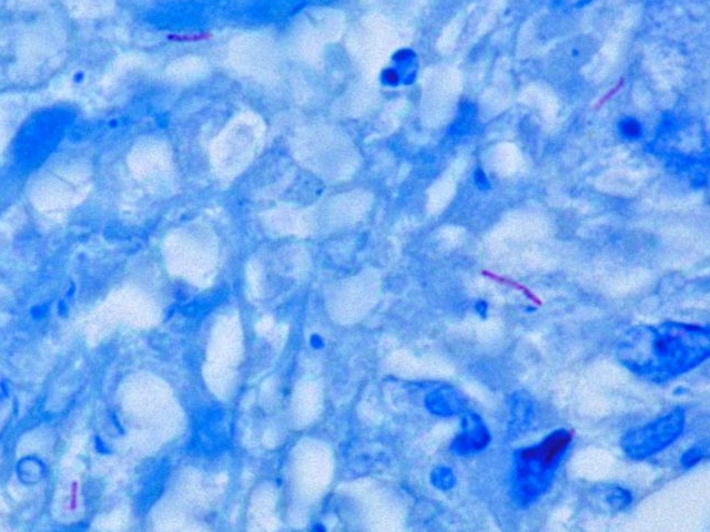 Mycobacterium tuberculosis stained red using Ziehl Neelsen stain