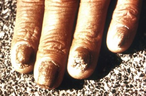 Tinea unguium, dermatophytosis involving nail bed