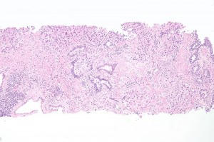 urothelial carcinoma